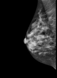 digital mammography image of a breast