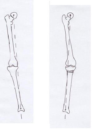 bowlegged leg